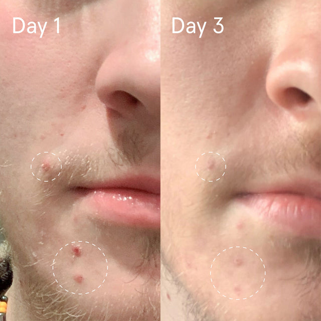 Sulfur spot treatment results day 1 with inflamed acne near mouth versus day 3 with reduced acne near mouth